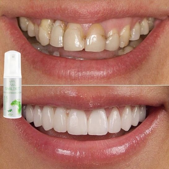 SmileKit – Espuma Dental Suave que Blanquea y Refresca