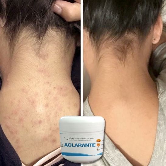 2 Crema Aclarante Despigmentante – Reduce Manchas, Melasma y Pecas –60 g