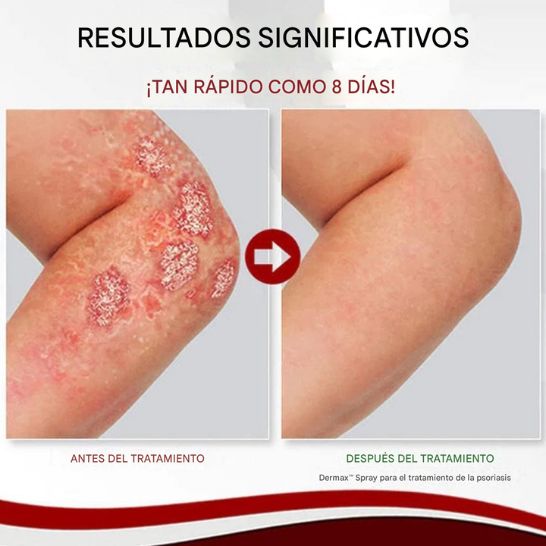 Dermax Tratamiento Vegetal para Psoriasis